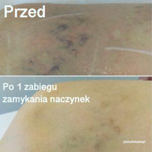 laserowe zamykanie naczynek efekty