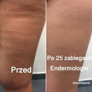 efekty po 25 zabiegach endermologii