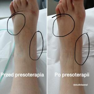 presoterapia