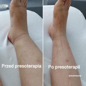 presoterapia w studio laser