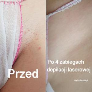 efekt po 4 zabiegach depilacji laserowej