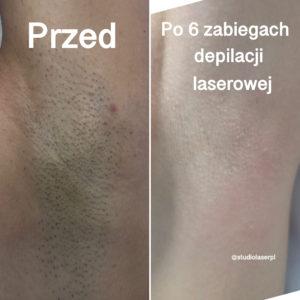 depilacja laserowa efekty