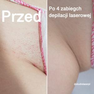 po 4 zabiegach depilacji laserowej - miejsca intymne