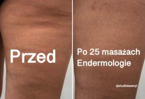 endermologia efekty