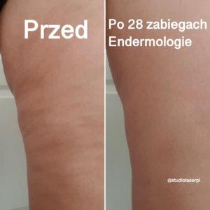 efekty endermologii