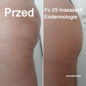 endermologia - efekty