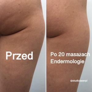 endermologia - efekty zabiegu