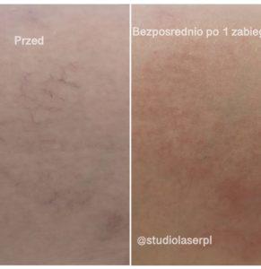 Usuwanie naczynek w Studio Laser 2