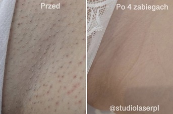 depilacja laserowa